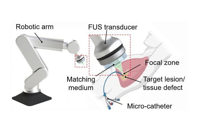 Une nouvelle méthode permet l'impression 3D directement à l'intérieur du corps humain